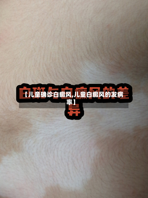 【儿童确诊白癜风,儿童白癜风的发病率】-第2张图片