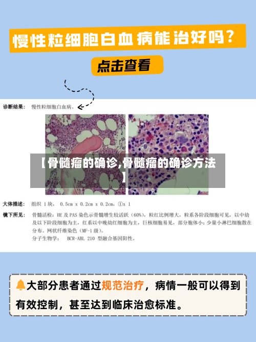 【骨髓瘤的确诊,骨髓瘤的确诊方法】-第2张图片