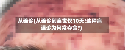 从确诊(从确诊到离世仅10天!这种病误诊为何常夺命?)-第3张图片