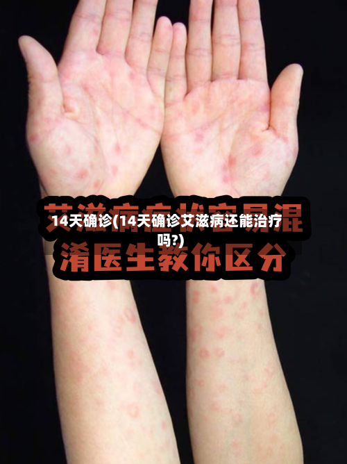 14天确诊(14天确诊艾滋病还能治疗吗?)-第3张图片