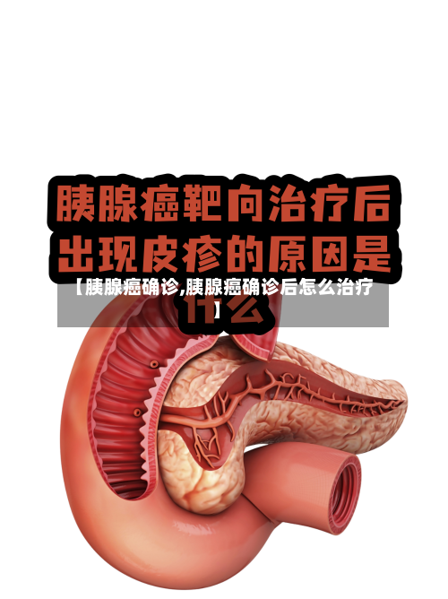 【胰腺癌确诊,胰腺癌确诊后怎么治疗】-第2张图片