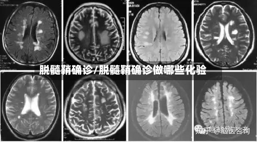 脱髓鞘确诊/脱髓鞘确诊做哪些化验-第2张图片
