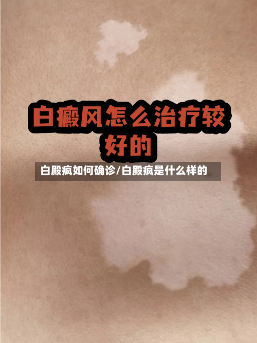 白殿疯如何确诊/白殿疯是什么样的