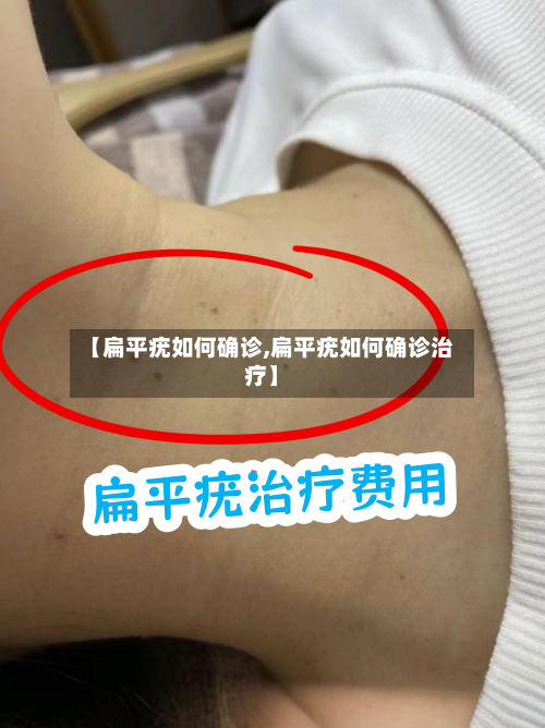 【扁平疣如何确诊,扁平疣如何确诊治疗】