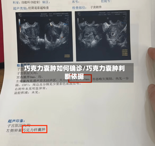 巧克力囊肿如何确诊/巧克力囊肿判断依据