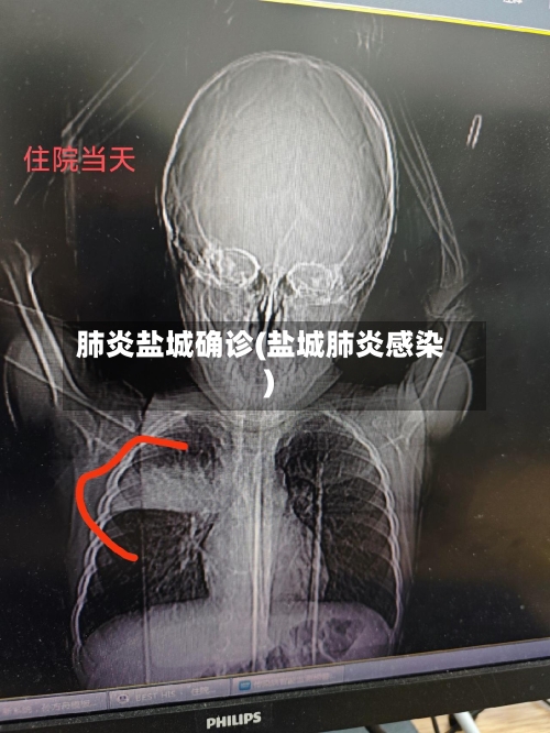 肺炎盐城确诊(盐城肺炎感染)-第3张图片