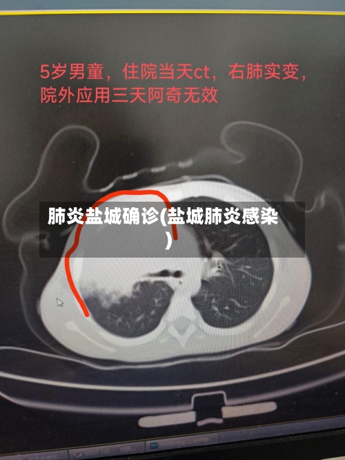 肺炎盐城确诊(盐城肺炎感染)-第2张图片