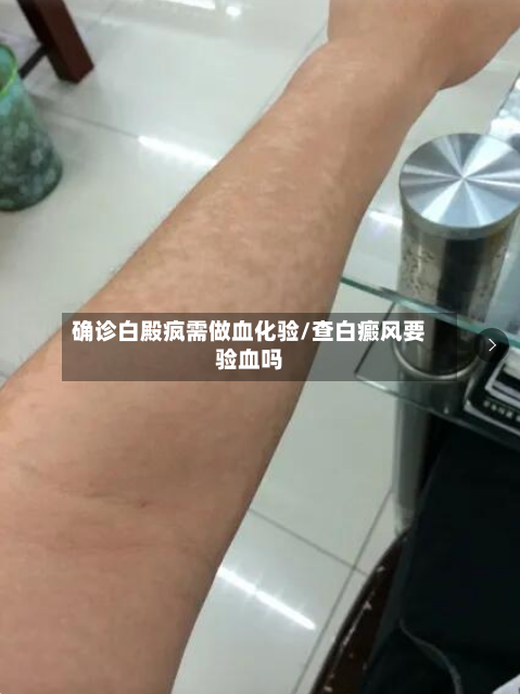 确诊白殿疯需做血化验/查白癜风要验血吗-第2张图片