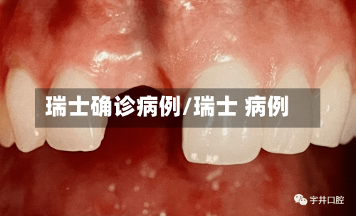 瑞士确诊病例/瑞士 病例