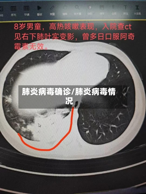 肺炎病毒确诊/肺炎病毒情况