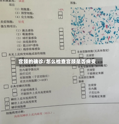 宫颈的确诊/怎么检查宫颈是否病变