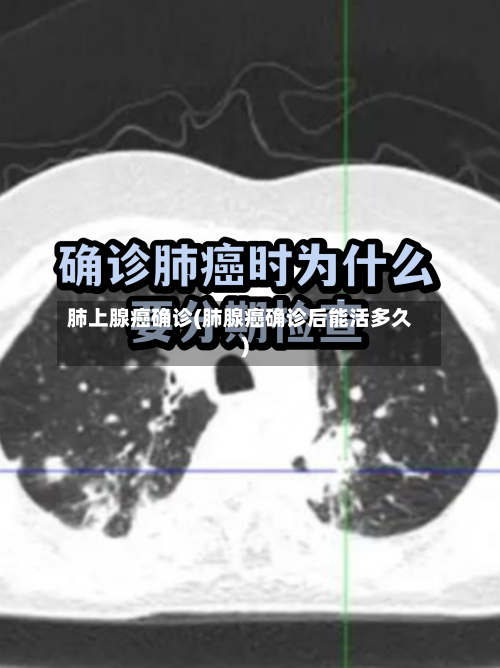 肺上腺癌确诊(肺腺癌确诊后能活多久)