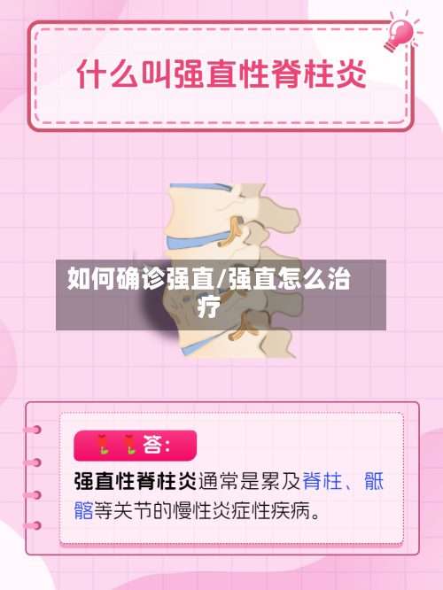 如何确诊强直/强直怎么治疗