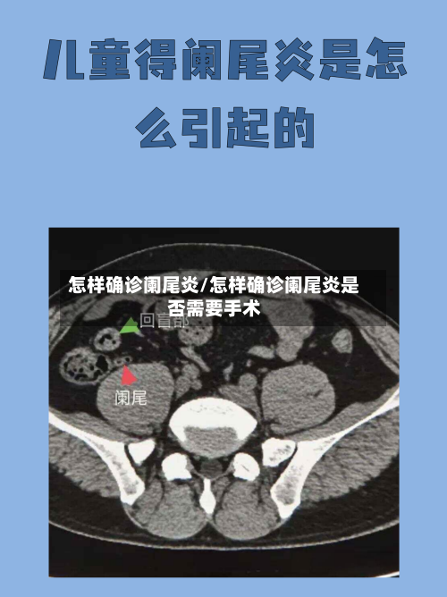 怎样确诊阑尾炎/怎样确诊阑尾炎是否需要手术