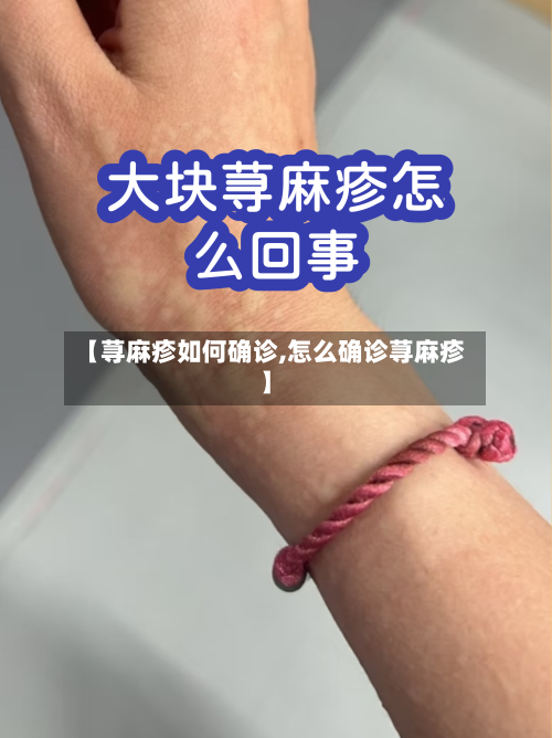 【荨麻疹如何确诊,怎么确诊荨麻疹】