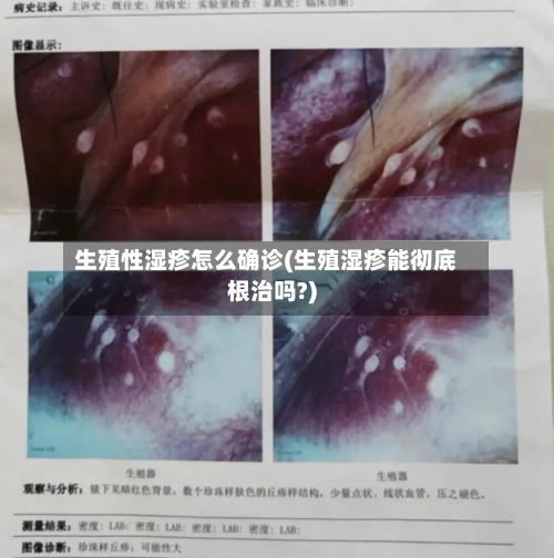 生殖性湿疹怎么确诊(生殖湿疹能彻底根治吗?)