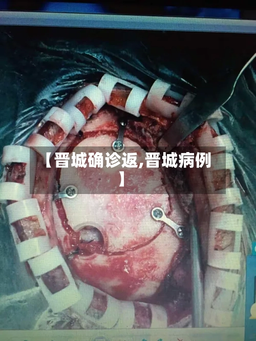 【晋城确诊返,晋城病例】