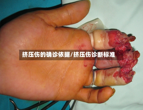 挤压伤的确诊依据/挤压伤诊断标准