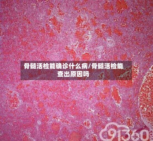 骨髓活检能确诊什么病/骨髓活检能查出原因吗-第3张图片