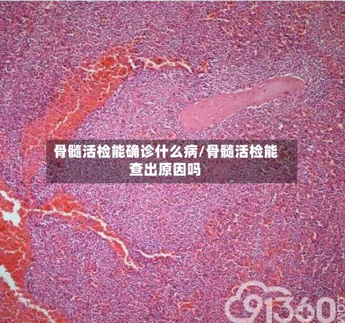 骨髓活检能确诊什么病/骨髓活检能查出原因吗
