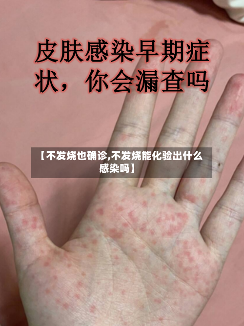 【不发烧也确诊,不发烧能化验出什么感染吗】-第3张图片