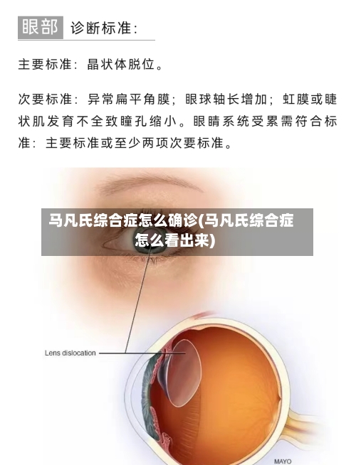 马凡氏综合症怎么确诊(马凡氏综合症怎么看出来)