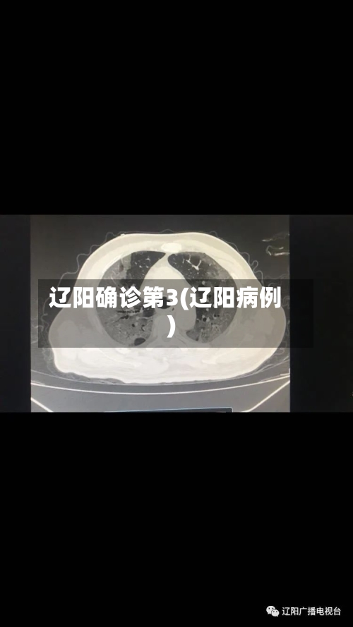 辽阳确诊第3(辽阳病例)-第2张图片