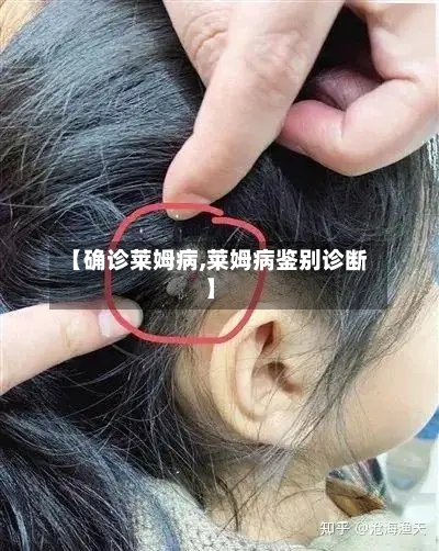 【确诊莱姆病,莱姆病鉴别诊断】