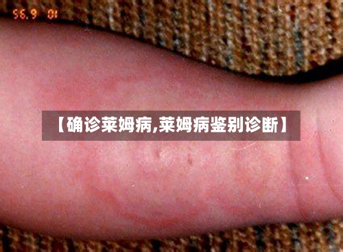 【确诊莱姆病,莱姆病鉴别诊断】-第2张图片