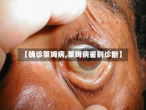 【确诊莱姆病,莱姆病鉴别诊断】-第3张图片
