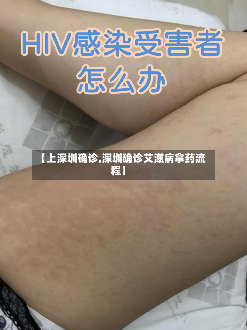 【上深圳确诊,深圳确诊艾滋病拿药流程】-第2张图片