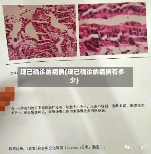现已确诊的病例(现已确诊的病例有多少)-第3张图片