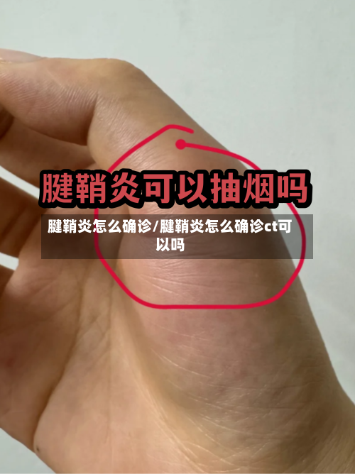 腱鞘炎怎么确诊/腱鞘炎怎么确诊ct可以吗-第2张图片