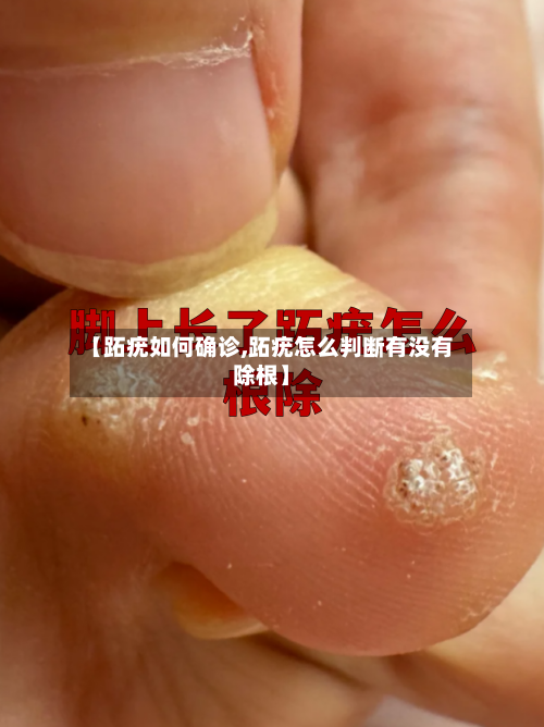 【跖疣如何确诊,跖疣怎么判断有没有除根】