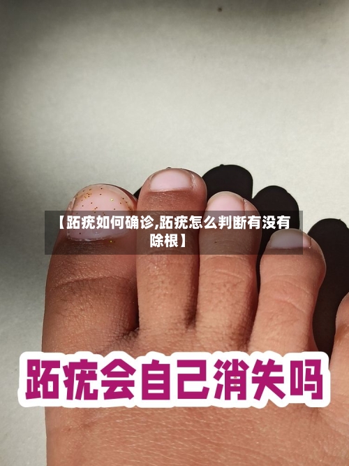 【跖疣如何确诊,跖疣怎么判断有没有除根】-第2张图片