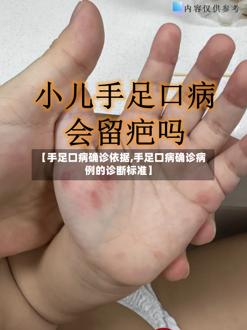 【手足口病确诊依据,手足口病确诊病例的诊断标准】