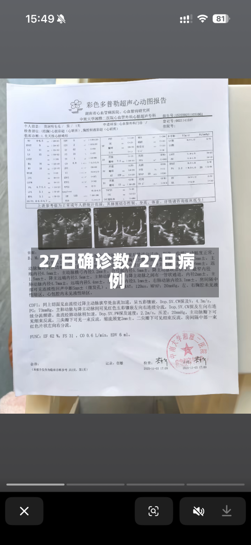 27日确诊数/27日病例-第3张图片