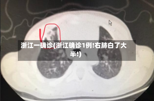 浙江一确诊(浙江确诊1例!右肺白了大半!)