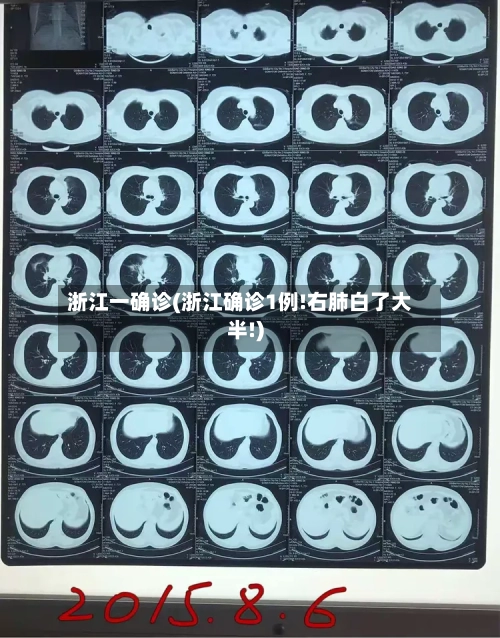 浙江一确诊(浙江确诊1例!右肺白了大半!)-第3张图片