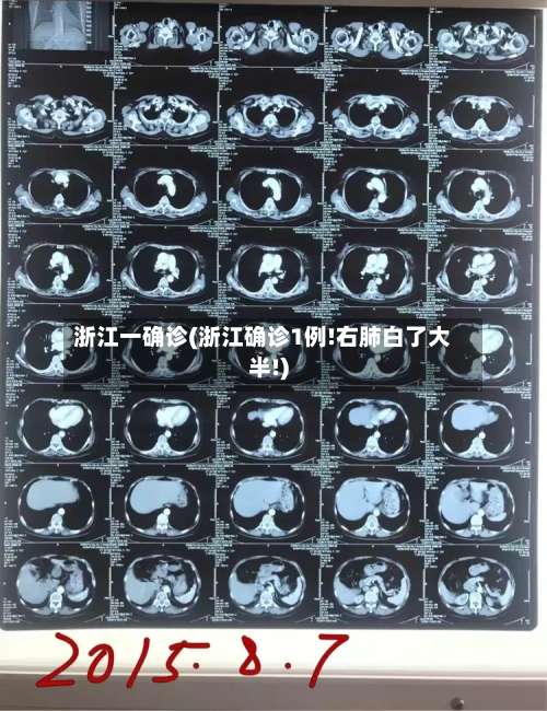 浙江一确诊(浙江确诊1例!右肺白了大半!)-第2张图片