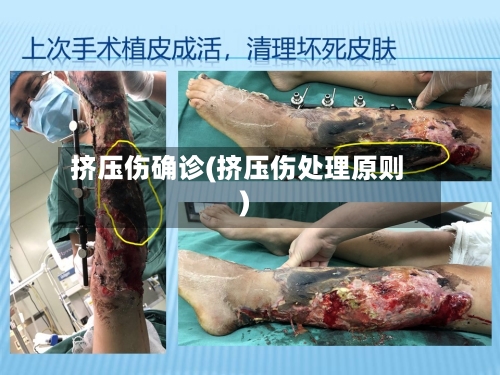 挤压伤确诊(挤压伤处理原则)-第3张图片