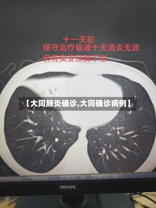 【大同肺炎确诊,大同确诊病例】-第2张图片