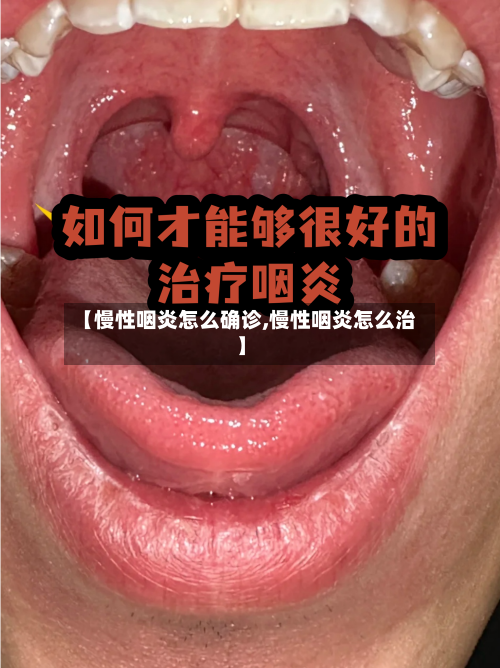 【慢性咽炎怎么确诊,慢性咽炎怎么治】-第2张图片