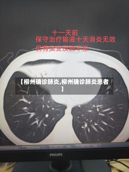 【柳州确诊肺炎,柳州确诊肺炎患者】-第3张图片