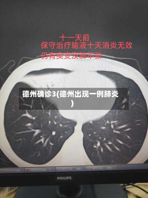 德州确诊3(德州出现一例肺炎)