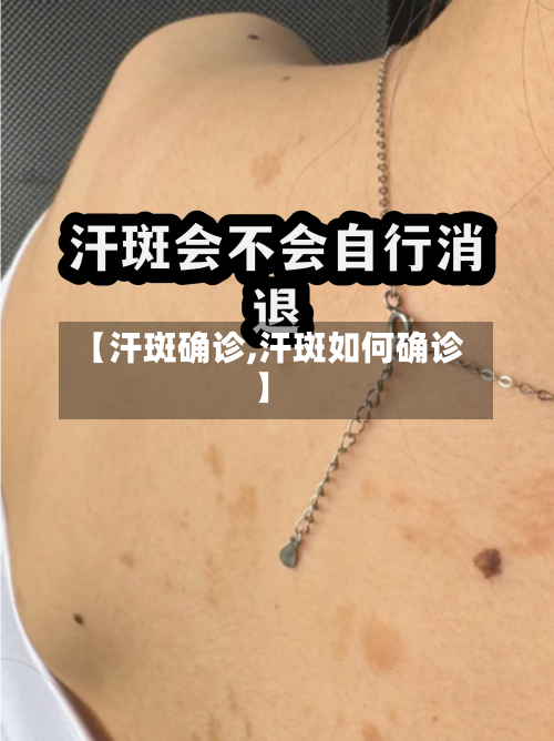 【汗斑确诊,汗斑如何确诊】