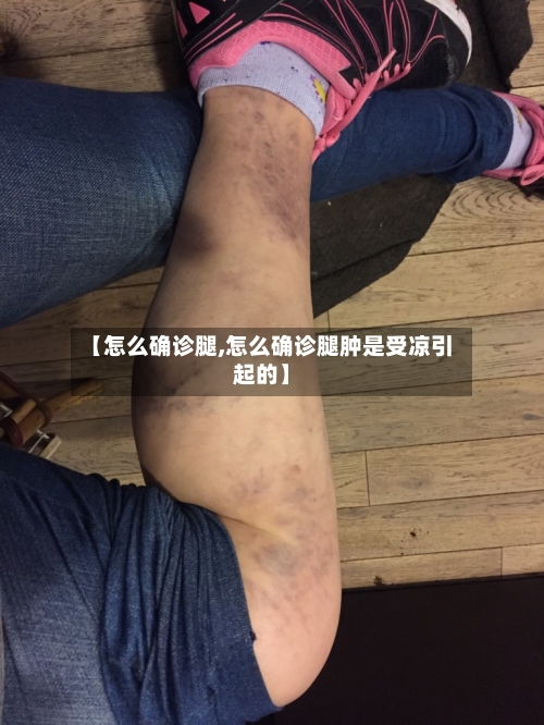【怎么确诊腿,怎么确诊腿肿是受凉引起的】-第2张图片