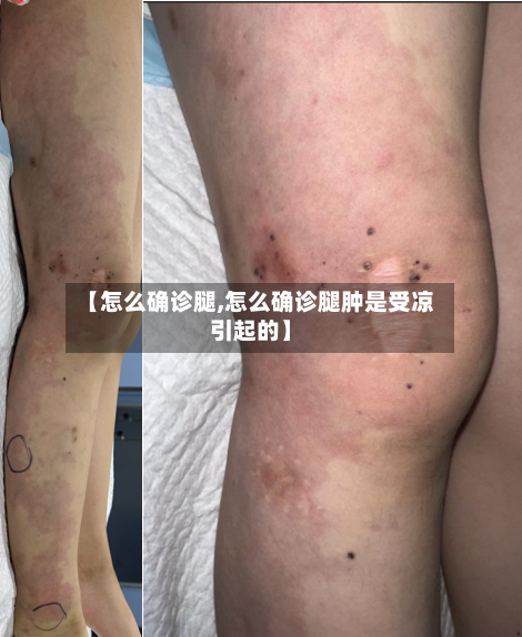 【怎么确诊腿,怎么确诊腿肿是受凉引起的】