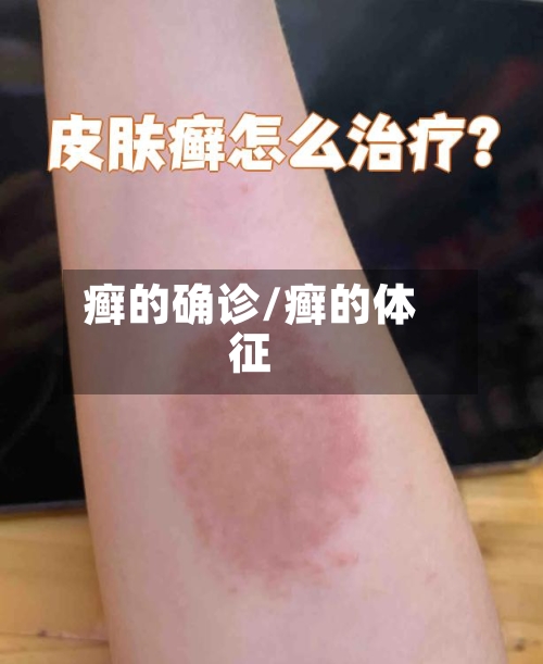 癣的确诊/癣的体征