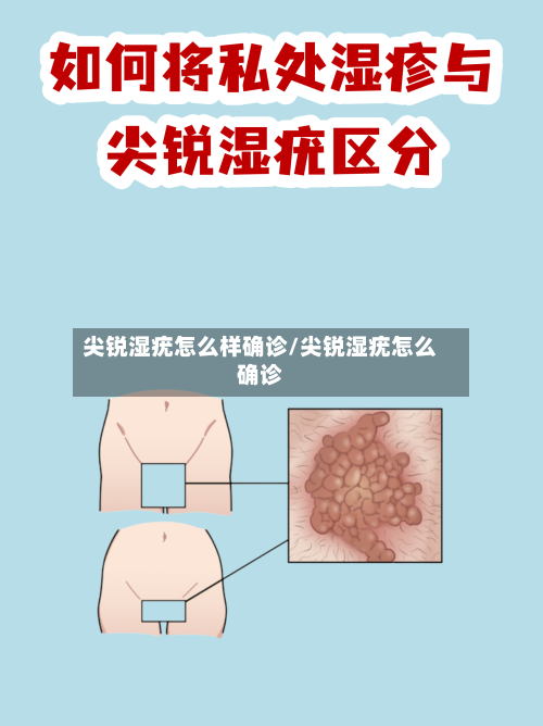尖锐湿疣怎么样确诊/尖锐湿疣怎么确诊